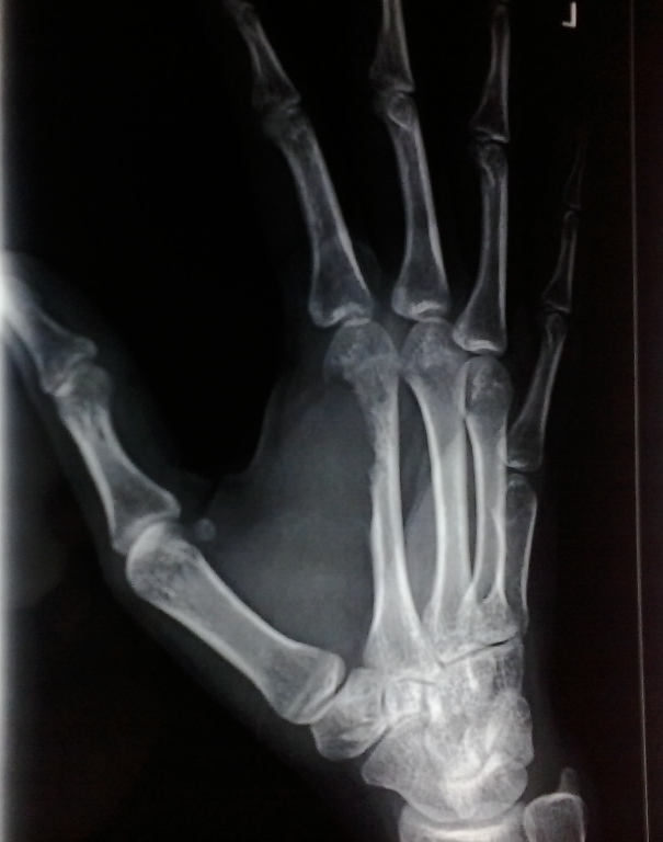 Shows pre-operative x-ray of Giant cell tumor of tendon sheath involving second metacarpal bone